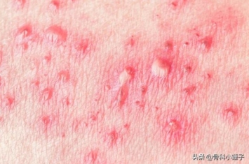 单纯疱疹的诊断标准是,男性单纯疱疹的症状