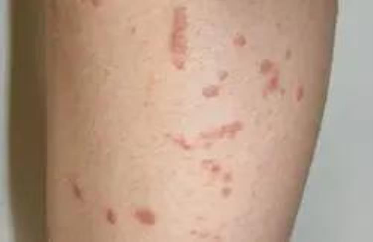 当皮肤出现红斑或者丘疹时该怎么办,全身皮肤出现红色斑丘疹