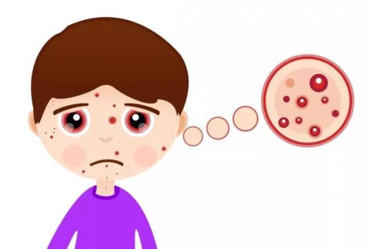 关于小儿麻疹你了解多少有宝宝的家长们要注意这些症状,小孩麻疹要注意什么