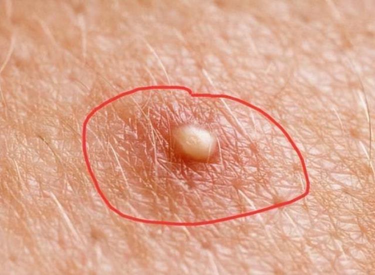 怎么会是hpv医生提醒皮肤3个异常或不是过敏,皮肤接触到hpv就会感染吗