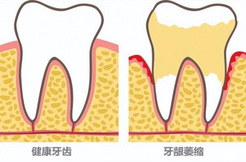 孕期为什么会牙龈萎缩,为什么会产生牙龈萎缩