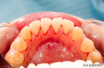 孕期为什么会牙出血,牙龈老是出血怎么回事