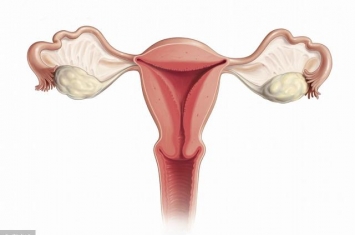 孕期息肉手术为什么会流产,两种类型的宫颈息肉供你认识