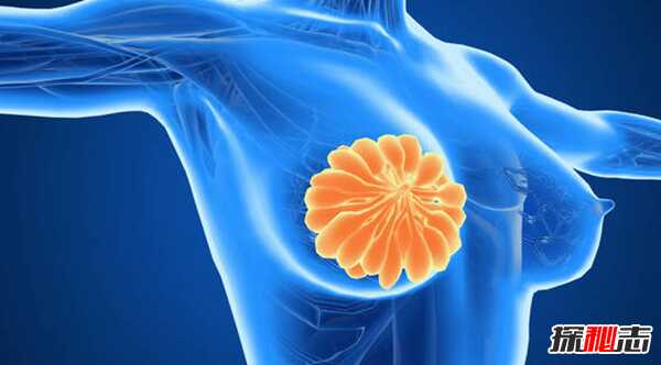 乳腺癌是怎么引起的?乳房癌症的十大早期信号