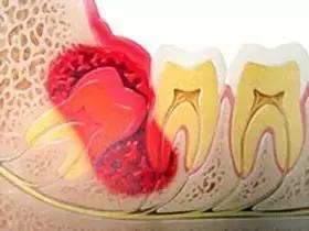 为什么孕期蛀牙烂的快,女性怀孕期间为什么容易智齿发炎
