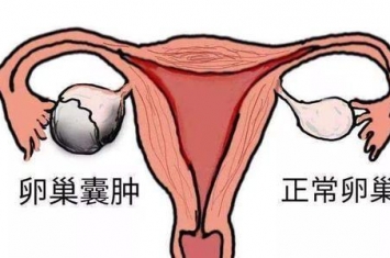 孕期为什么黄体会形成囊肿,卵巢黄体囊肿和黄素囊肿有什么不同
