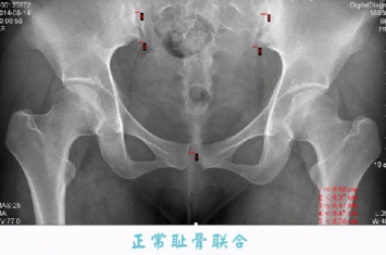 为什么孕期只有右边耻骨痛,原来是两块骨头在分离