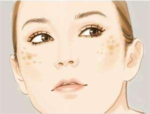 孕期为什么脸上突然长斑点,孕期如何预防脸上长斑